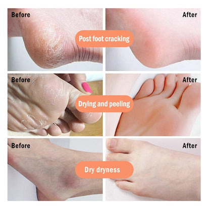 KURAIY Foot Crack Tea Tree Balm For Dry Cracked Heels & Feet Foot Cream & Hand Cream (50gm) ( For women and men) Pack of 1 Foot Creams & Lotions
