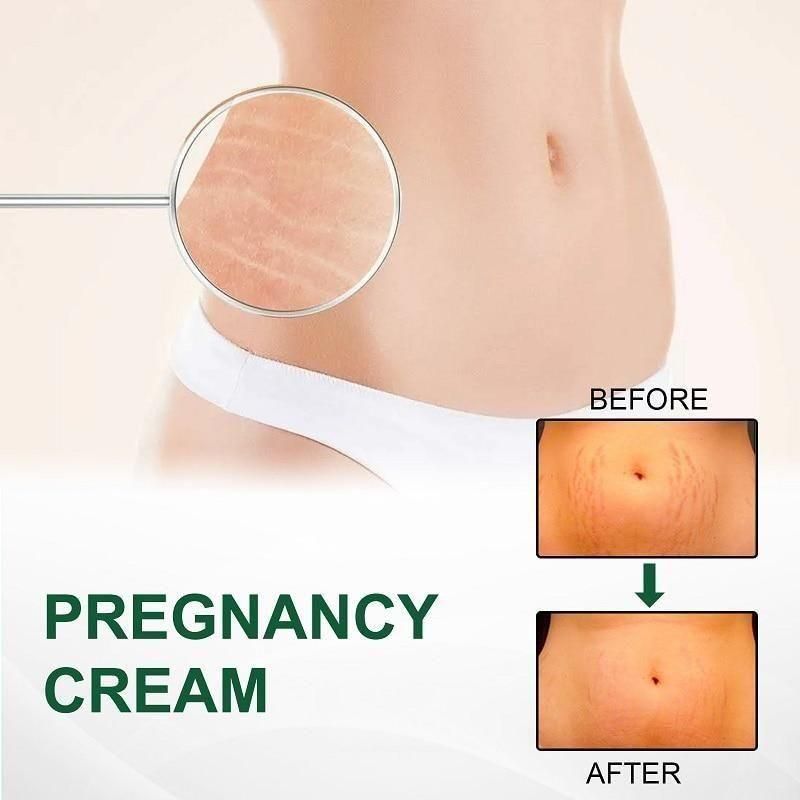KURAI Pregnancy Scars, Acne Removal Cream