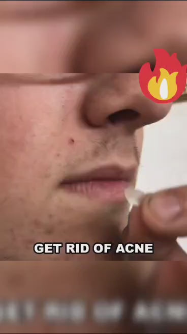 Acne Pimple Patch (72 Pieces)