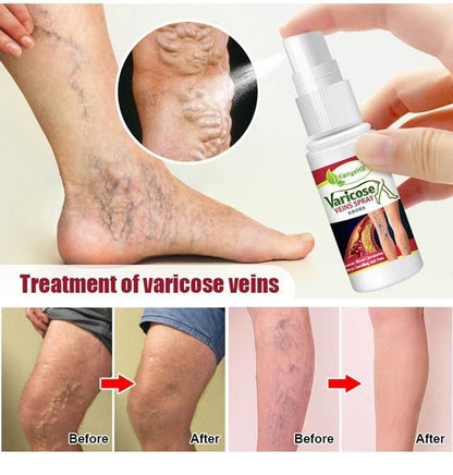 Vein Healing Varicose Veins Treatment Spray
